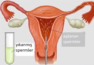 nfertilitede Tedavi Yntemleri 