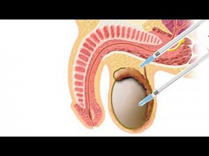 Testis Biopsisi (PESA, TESA, TESE, MESA) 